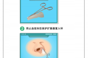 新品上市｜韬薄医疗一次性手术切口保护扩张器，为鼻科手术筑牢安全防线